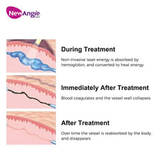 Newangie® Alexandrite Hair Removal Machine