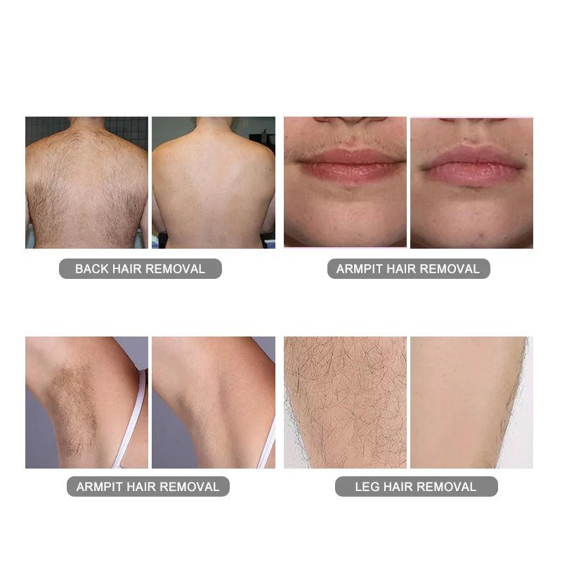 Newangie® Vertical Laser Hair Removal Machine - BM205.